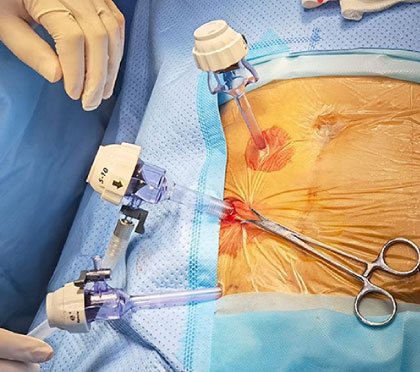 Chirurgie pariétale